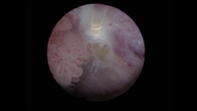 Лазерная тулиевая en-block резекция стенки мочевого пузыря с опухолью